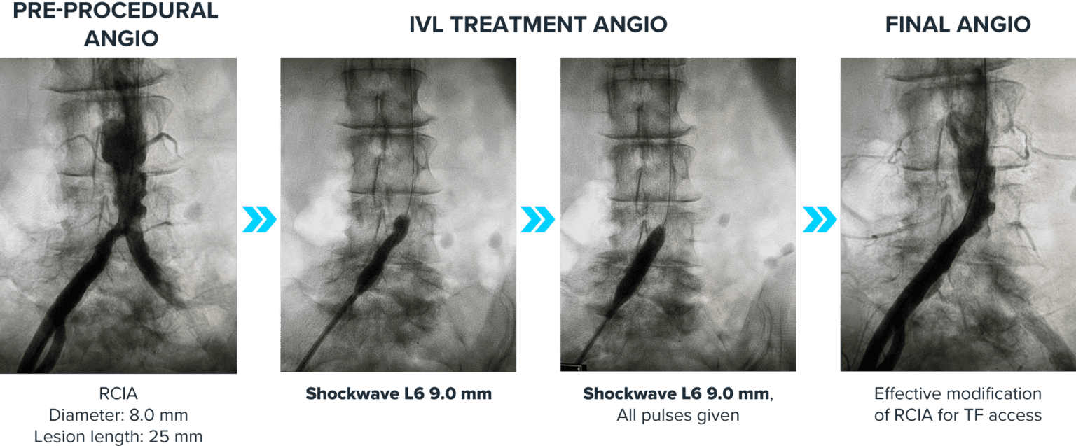 Shockwave IVL For PreTAVR Shockwave Medical