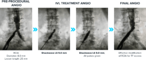 Series of four angiogram images showing the use of intravascular lithotripsy (IVL) to modify the right common iliac artery (RCIA) in preparation for transfemoral access in TAVI