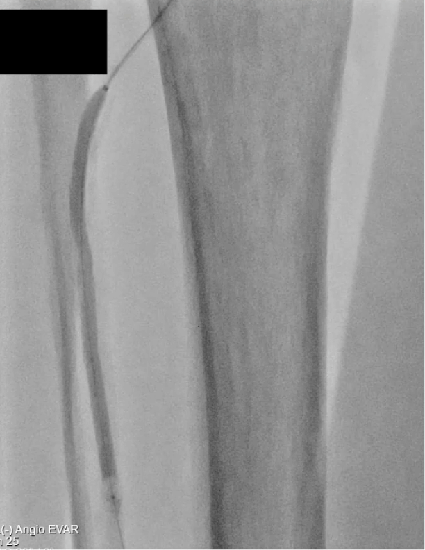angio showing 3rd cycle with Shockwave E8