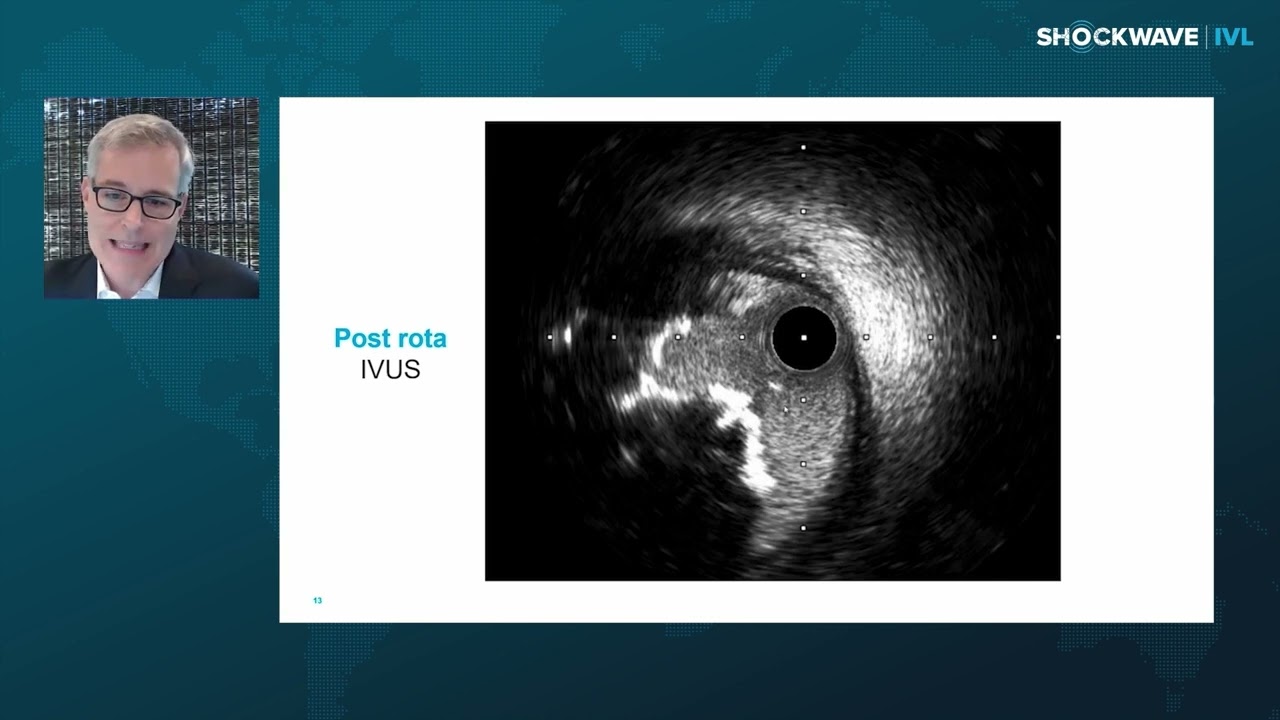 Image for Consistency Across the Sexes: IVL is Safe & Effective in Modifying Nodular Calcium in Men & Women<sup src=