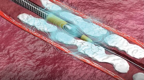 Illustrated image demonstrating how gentle forward pressure is applied while the Shockwave Javelin Peripheral IVL Catheter generates sonic pressure waves to crack calcified lesions ahead of the catheter within the vasculature