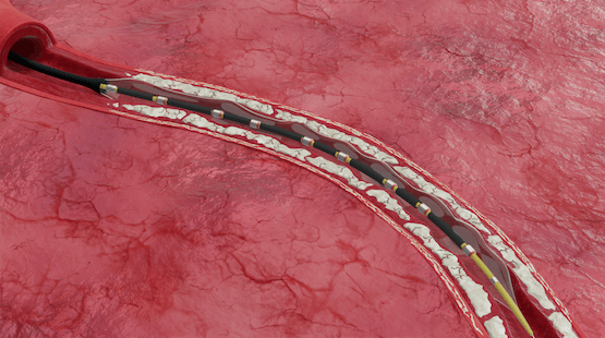 Image for Improve arterial compliance