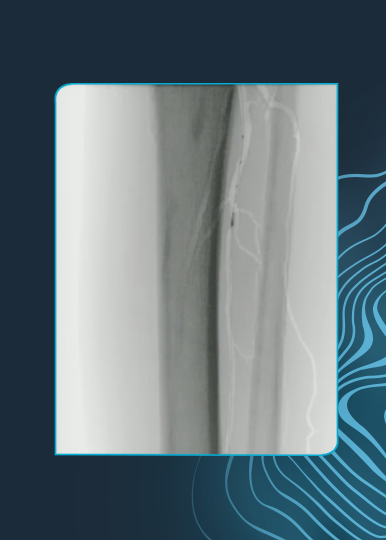 Critical Limb Ischemia: Right Anterior Tibial & Dorsalis Pedis Revascularization Using Shockwave Javelin