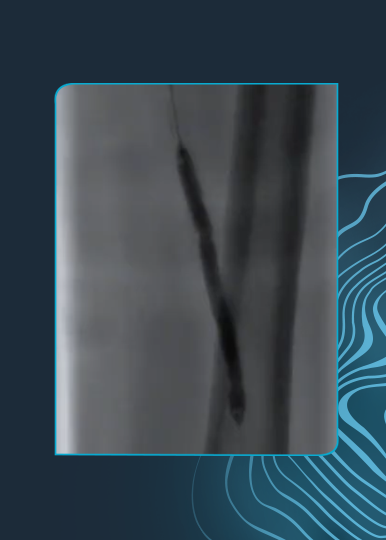 Left Superficial Femoral Artery Revascularization Using Shockwave IVL With IVUS Guidance