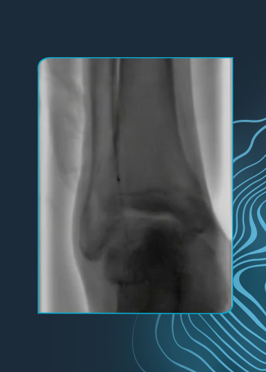 Limb-Threatening Ischemia With Hallux Ulcer Treated Using Shockwave IVL Javelin