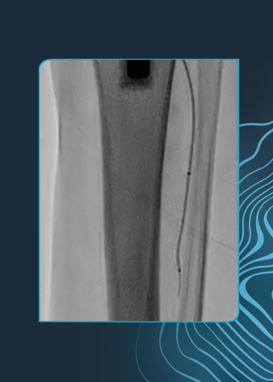 Multi-Level High-Grade Peripheral Artery Disease Treated With Shockwave IVL and DCB Therapy