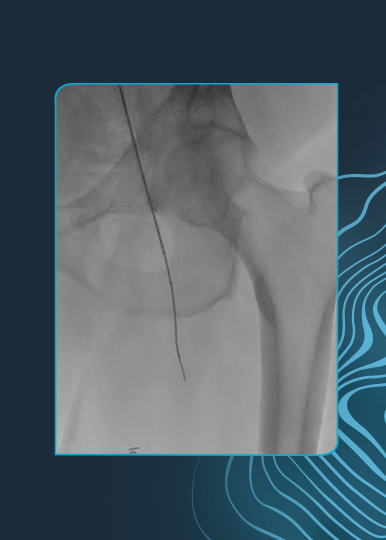 Superficial Femoral–Popliteal Occlusion Treated With Shockwave IVL and Stenting