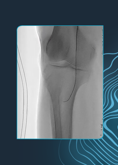Tibial-Peroneal Trunk Stenosis Managed With Shockwave IVL and Drug-Coated Balloon Angioplasty