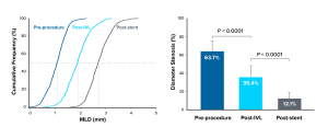 Graphic of two charts showing the procedural angiographic outcomes following IVL treatment. Chart one is a line chart of the cumulative frequency; chart two is a bar chart of the diameter stenosis pre-procedure, post-IVL, and post-stent