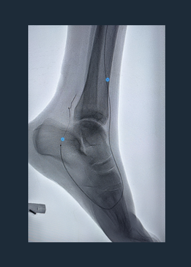 Moving Calcium Modification Forward: Shockwave Javelin Case Review