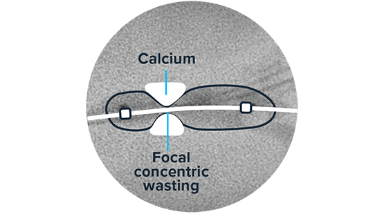 Image for Inadequate Compliance: Asymmetrical Balloon Expansion 