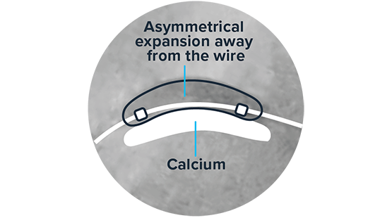 Image for Inadequate Compliance: Asymmetrical Balloon Expansion 