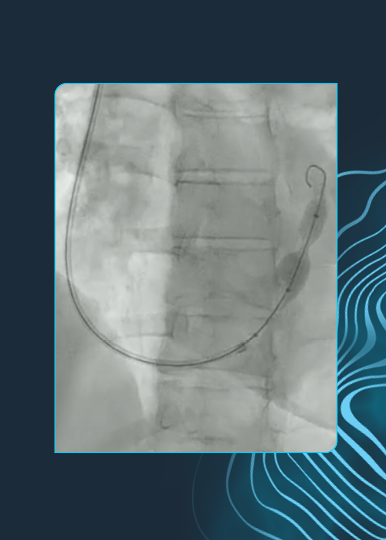 Evidence in Action: Advancing Care for Angina with Shockwave Reducer